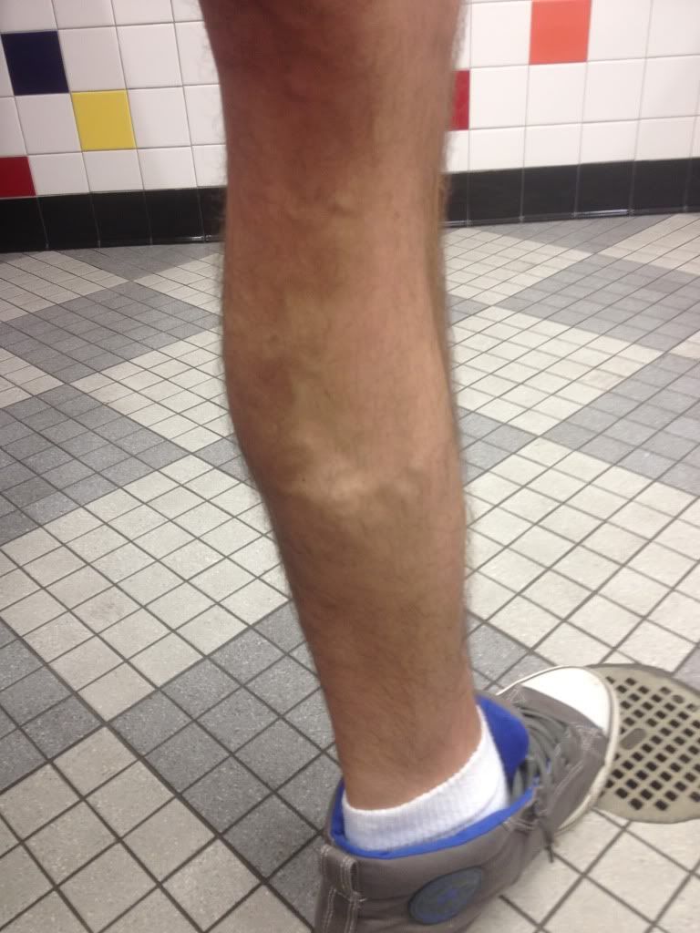 Misc Doctors Lump On My Calf Help Srs Pic Forums
